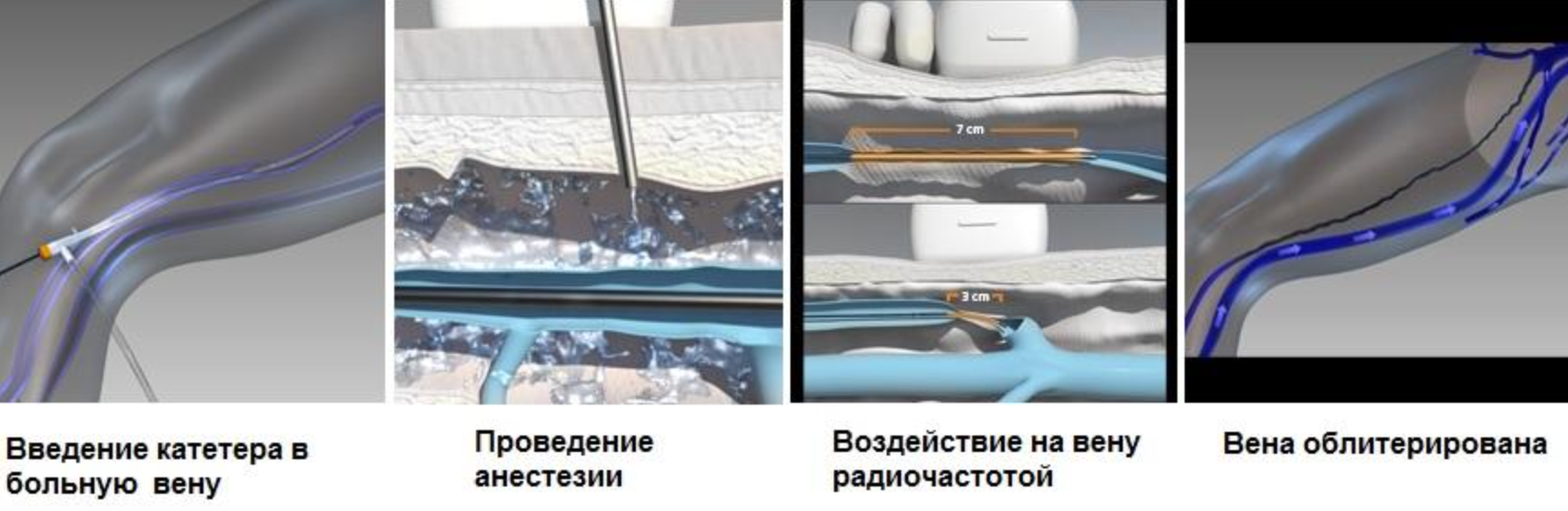 Радиочастотная абляция вен. Радиочастотная абляция нижних конечностей.